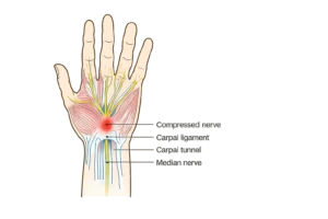 Carpal Tunnel Syndrome​